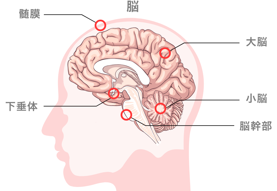 脳腫瘍とは